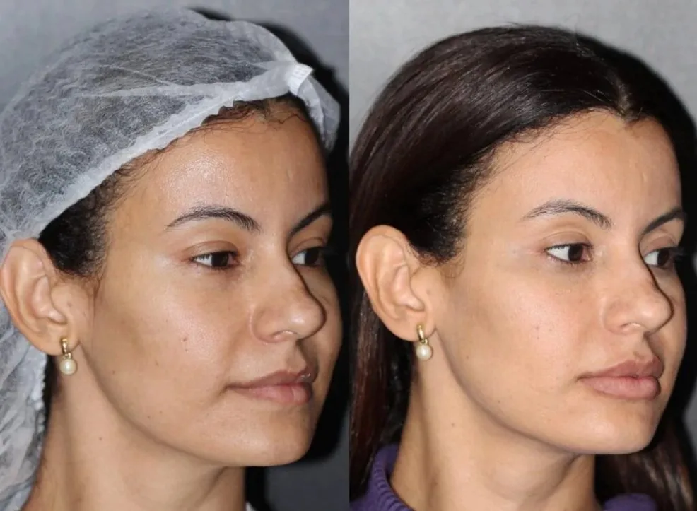 Antes y después rejuvenecimiento facial Medellín — óvalo facial