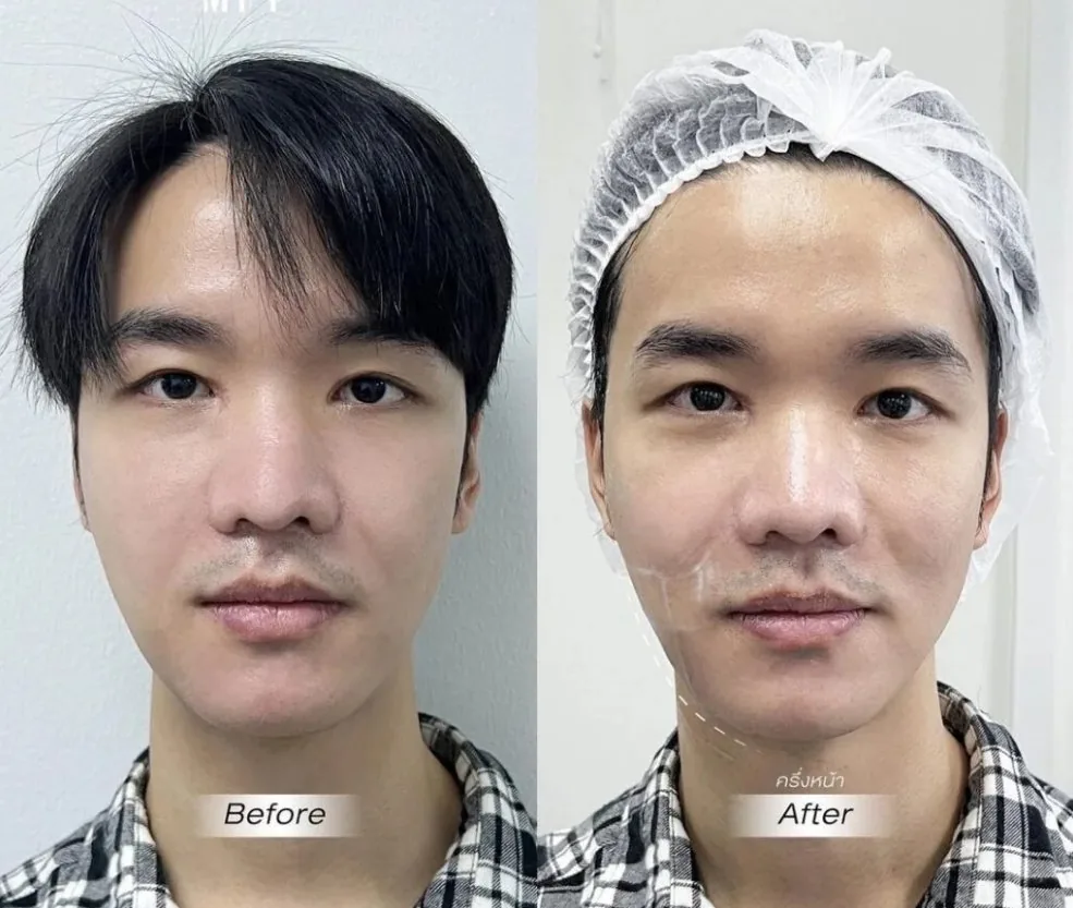 Rejuvenecimiento facial rostro Medellín
