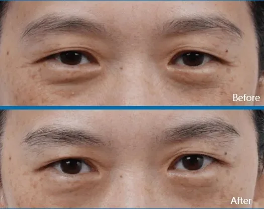 Rejuvenecimiento contorno ojos Medellín